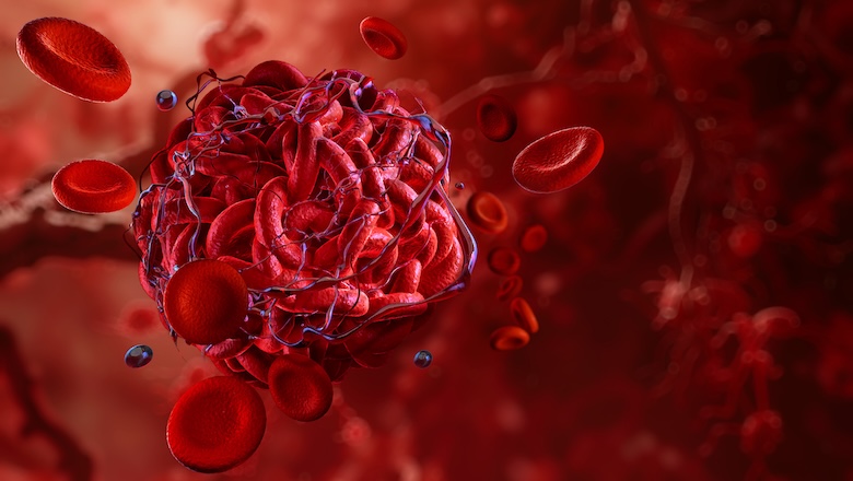 Blood clot in artery, emphasizing thrombosis, coagulation process, red blood cells, fibrin strands. Heart attack, vein disease prevention, diagnosis, treatment in healthcare. Blood clot formation 3D